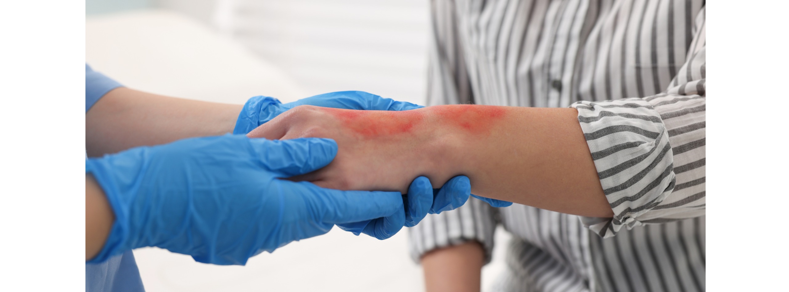 Varicose Treatment